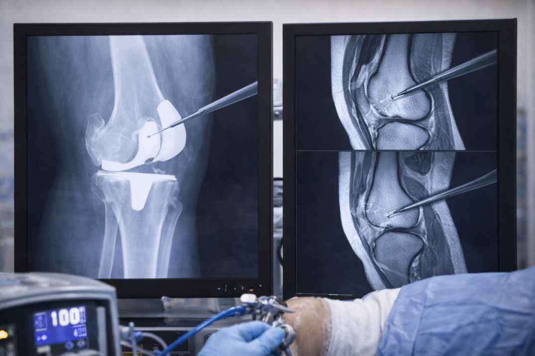 Orthopedic knee imaging showing joint replacement and arthroscopic instrument guidance on monitor