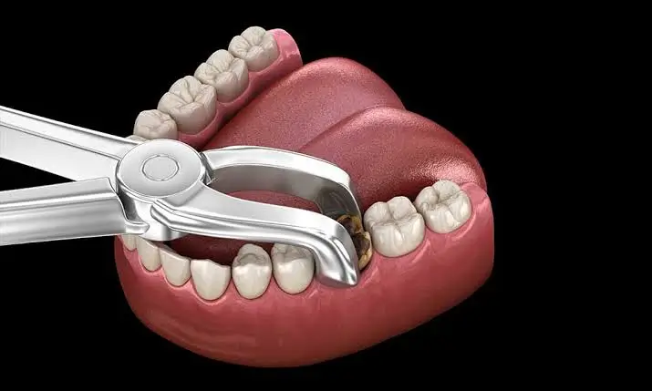 3D illustration of a molar tooth extraction using dental forceps to remove a severely decayed tooth during an oral surgery procedure.