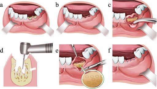 Step-by-step illustration of socket preservation with dental bone grafting after tooth extraction to promote jawbone regeneration and prepare for future dental implant placement.