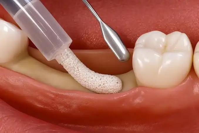 Bone graft material being placed into the jawbone socket after tooth extraction to preserve bone and prepare for future dental implant placement.