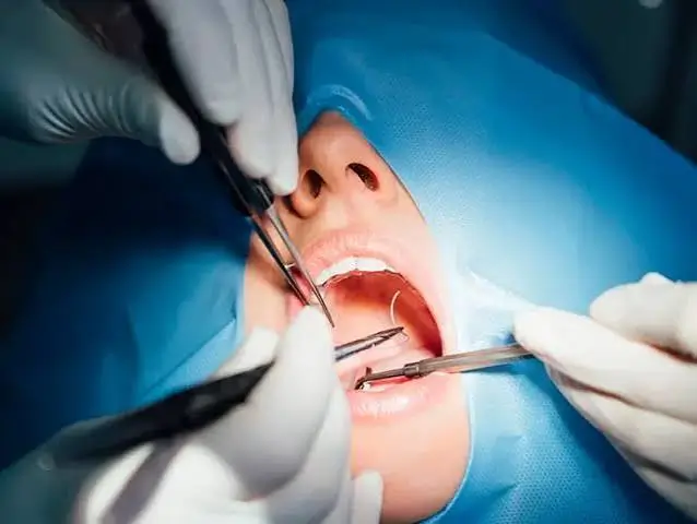 Oral surgeon performing a dental surgical procedure using precision instruments during a sterile oral surgery treatment.
