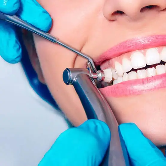 Close-up of a dentist performing professional teeth polishing and cleaning using a dental handpiece during a routine dental procedure.