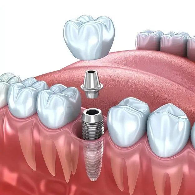 Dental implant procedure showing a titanium implant, abutment, and ceramic crown replacing a missing tooth for permanent smile restoration.