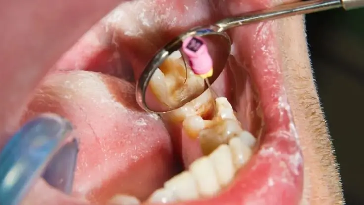 Dentist examining a decayed tooth with a dental mirror during a routine oral examination for cavity detection and treatment planning.