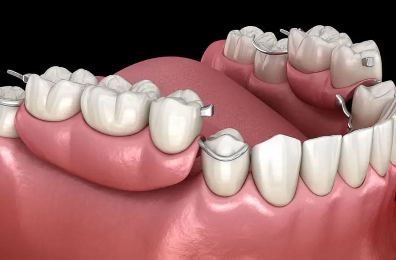 3D illustration of a removable partial denture with metal clasps replacing multiple missing teeth and restoring chewing function and smile aesthetics.