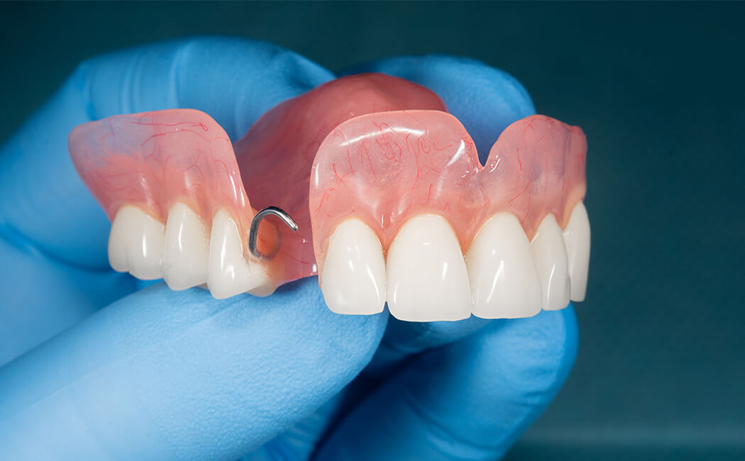 Custom removable partial denture with acrylic gum base, artificial front teeth, and metal clasp designed to replace multiple missing teeth and restore smile function