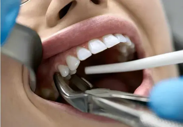 Dentist performing a tooth extraction using dental forceps during a safe and precise oral surgery procedure.