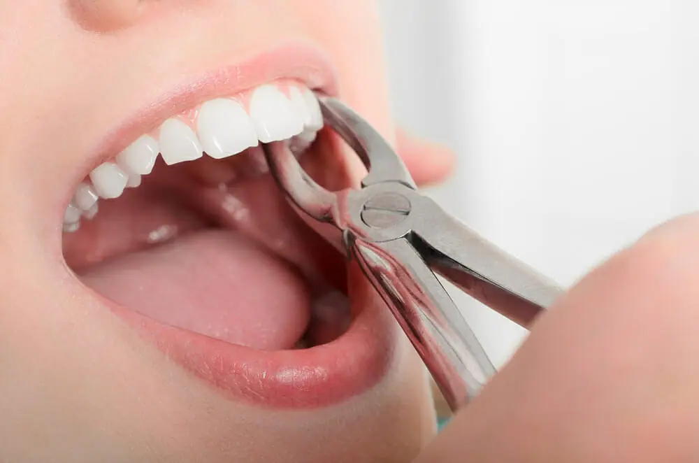 Dental forceps being used to perform a tooth extraction during a professional dental extraction procedure.