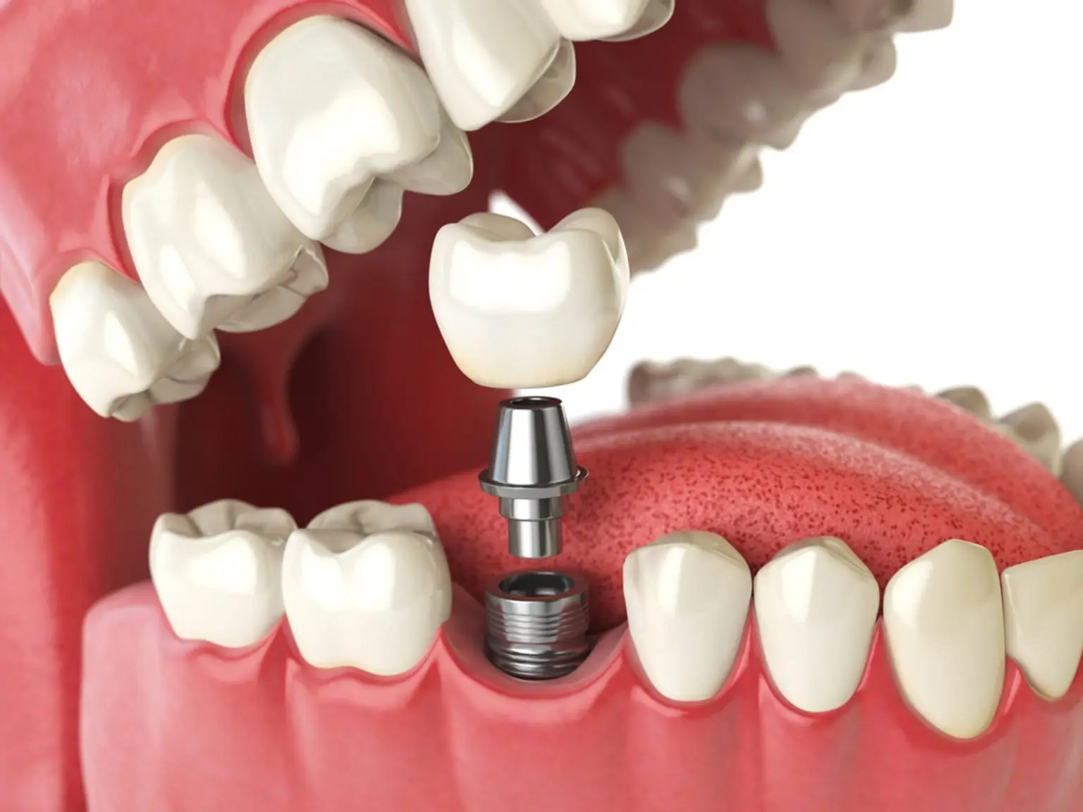 3D illustration of a single dental implant showing a titanium implant, abutment, and ceramic crown replacing a missing tooth in the lower jaw.