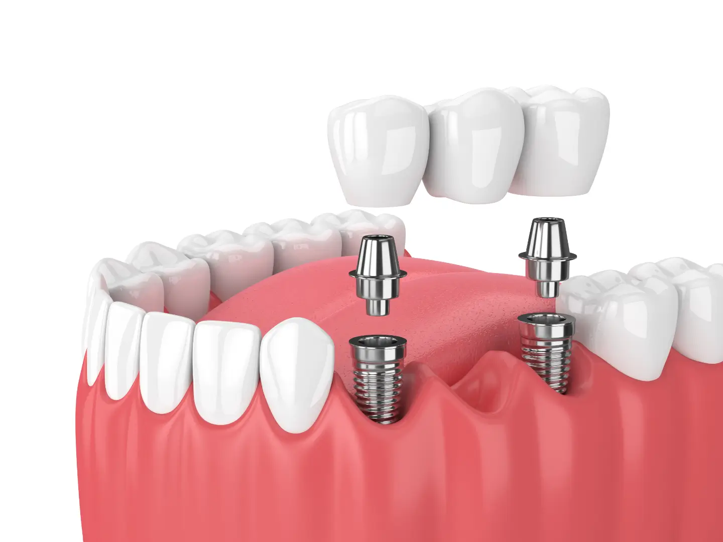 3D illustration of a dental implant bridge showing two titanium implants, abutments, and a three-unit ceramic bridge replacing missing teeth.