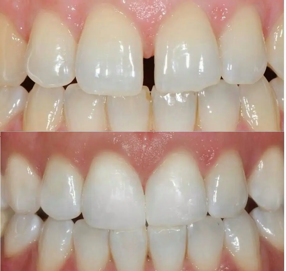 Before and after image showing successful diastema closure treatment with cosmetic dental bonding, eliminating the gap between the upper front teeth for a natural-looking smile