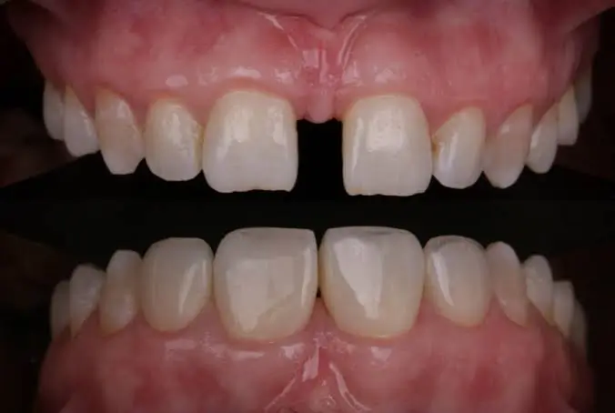 Before and after image of diastema closure treatment showing complete closure of the gap between the upper front teeth with natural-looking cosmetic dental restoration