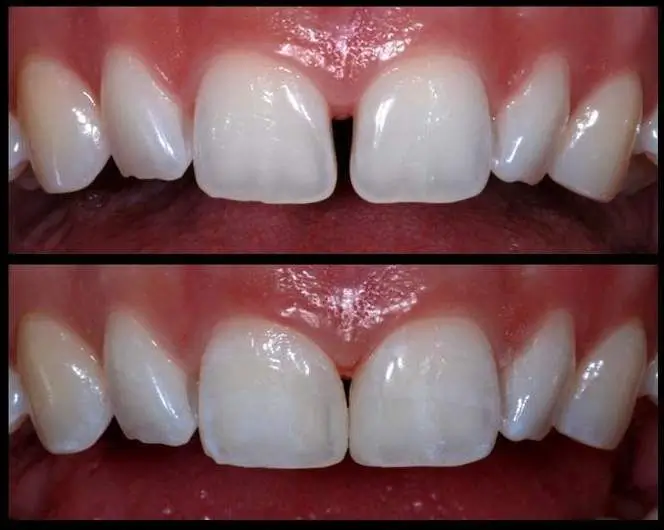 Before and after comparison of diastema closure treatment showing successful correction of the gap between the upper front teeth with natural-looking cosmetic dental result