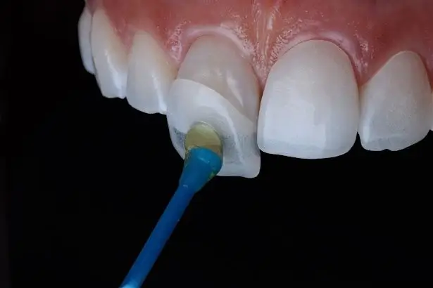 Dentist bonding a custom porcelain veneer to a prepared front tooth using dental adhesive during a cosmetic veneer placement procedure.