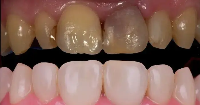 Before and after comparison of a discolored front tooth restored with a natural-looking porcelain veneer, improving tooth color, symmetry, and smile aesthetics.