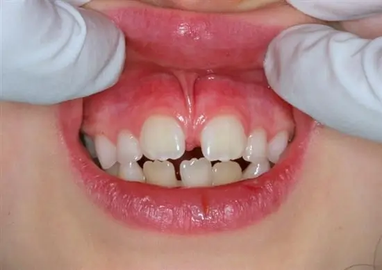 Child with a prominent upper labial frenulum (lip tie) and gap between the upper front teeth during a pediatric dental examination.