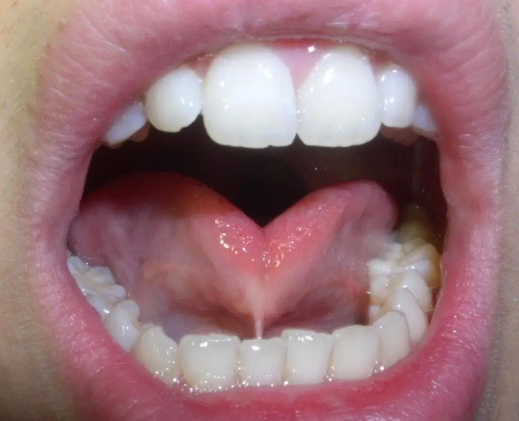 Child with a visible tongue-tie (ankyloglossia) showing a restricted lingual frenulum beneath the tongue during an oral examination.