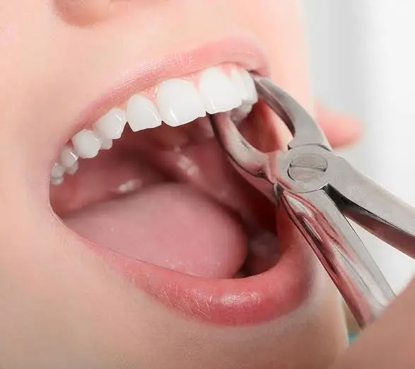 Dentist performing a safe tooth extraction using dental forceps during a professional tooth removal procedure.