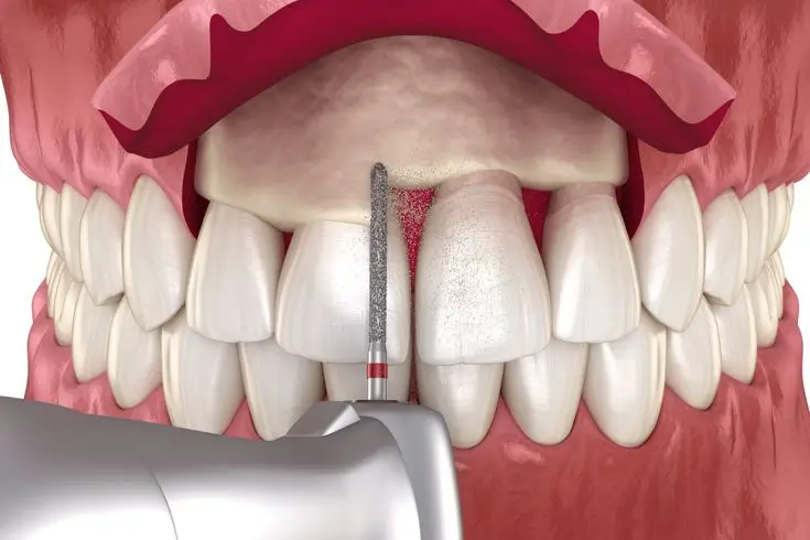 Illustration of a maxillary labial frenectomy procedure using a surgical bur to remove the upper labial frenulum for correction of a midline diastema