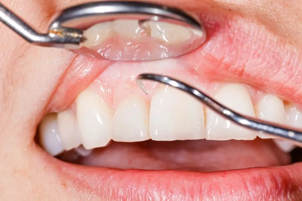 Dentist examining the upper labial frenulum with a dental mirror and explorer during a clinical evaluation for lip tie and gum health.