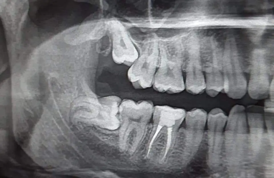 Panoramic dental X-ray (OPG) showing a horizontally impacted lower wisdom tooth, upper impacted third molar, adjacent molars, and jawbone for oral surgery assessment.