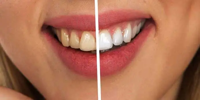 Before and after professional teeth whitening showing visibly brighter, stain-free teeth and an enhanced, radiant smile.