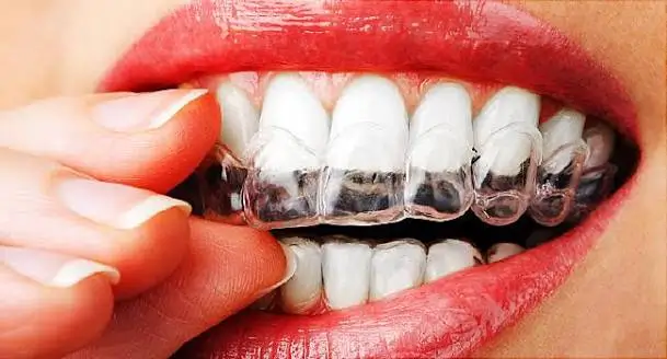 Person placing a custom clear teeth whitening tray over the upper teeth for an at-home professional teeth whitening treatment.