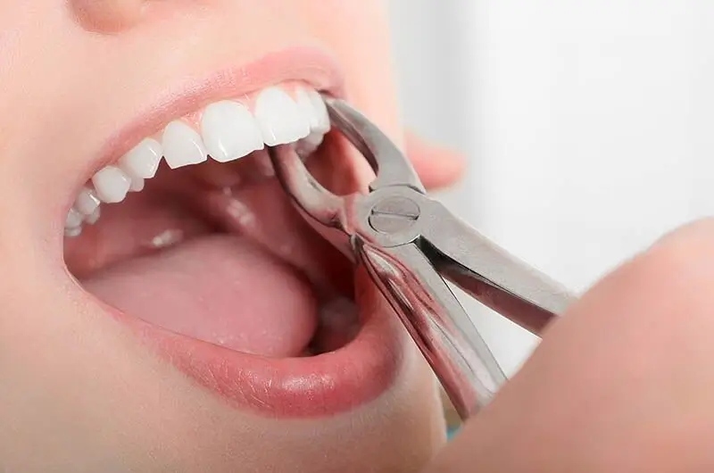 Dentist performing a professional tooth extraction using dental forceps during a safe and comfortable oral surgery procedure.