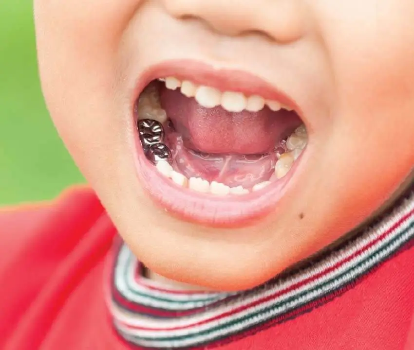 Child with stainless steel dental crowns on primary molars after pediatric restorative dental treatment.
