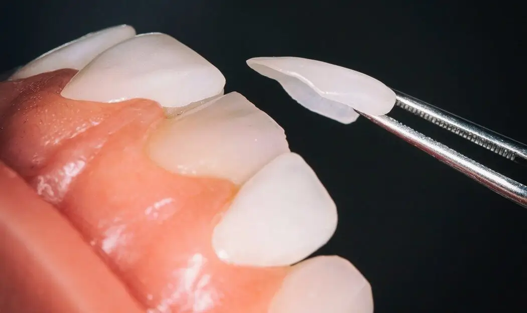 Porcelain veneer being positioned on a prepared front tooth during a cosmetic dental veneer procedure to enhance smile aesthetics.