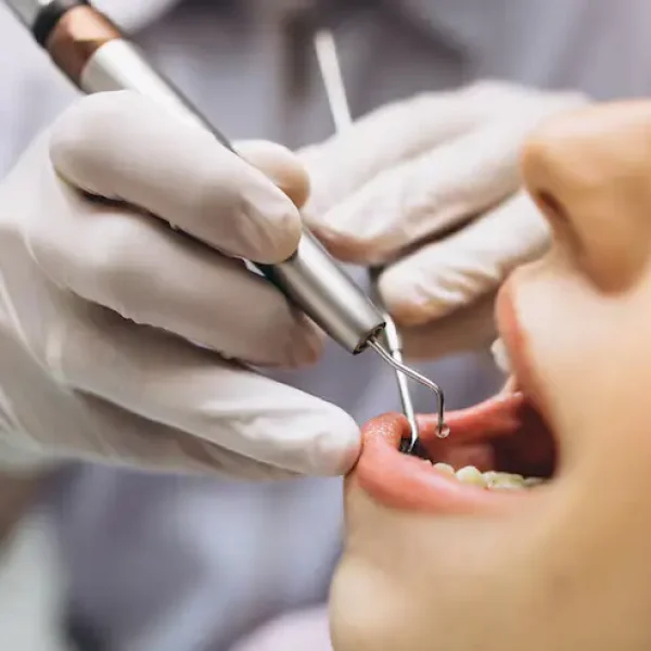 Dentist performing a professional dental cleaning using a scaler and dental mirror during an oral examination to remove plaque and maintain healthy teeth and gums