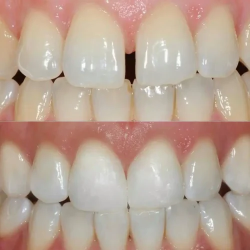 Before and after image showing successful diastema closure treatment with cosmetic dental bonding, eliminating the gap between the upper front teeth for a natural-looking smile
