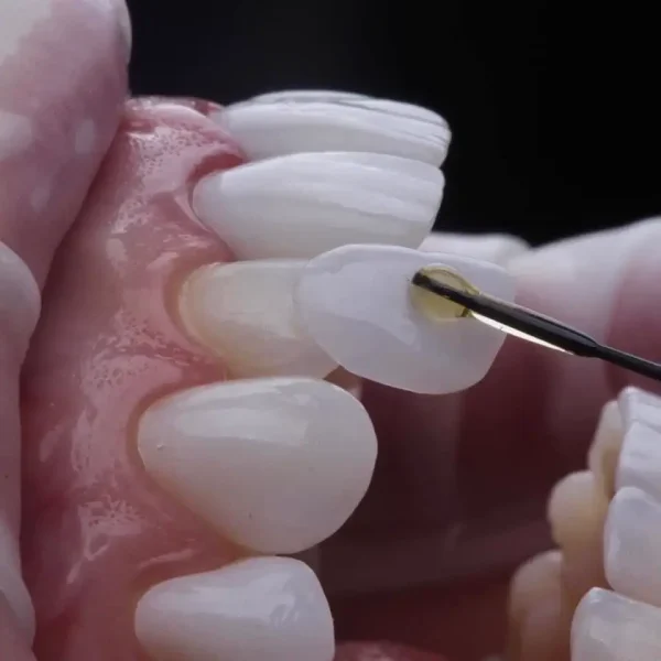 Dentist bonding a custom porcelain veneer onto a prepared front tooth using dental adhesive during a cosmetic veneer placement procedure.