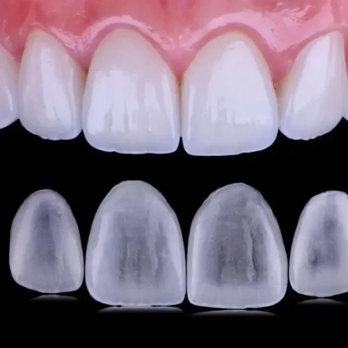 Custom porcelain veneers displayed below the upper front teeth, illustrating ultra-thin ceramic shells designed to enhance tooth shape, color, and smile aesthetics.
