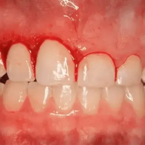 Clinical image showing a gingivectomy procedure with reshaped gum tissue around the upper front teeth to treat excessive gums and improve smile aesthetics