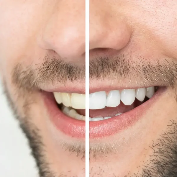 Before and after teeth whitening results showing a noticeably brighter, whiter smile following professional dental whitening treatment.
